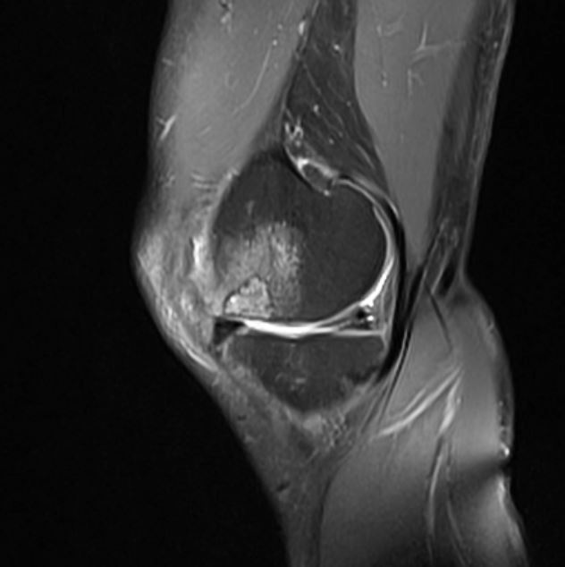 Spontaneous osteonecrosis of the knee (SONK)