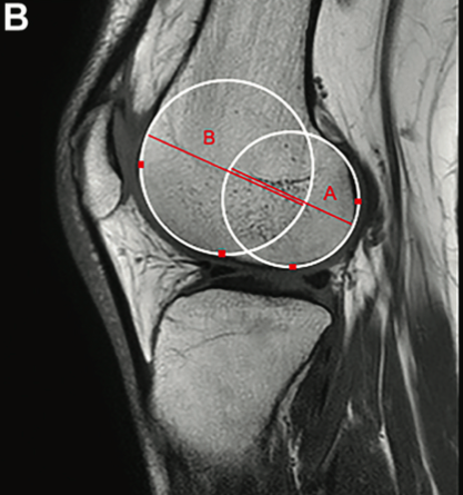 Lateral Femoral Condyle Index (LFCI)