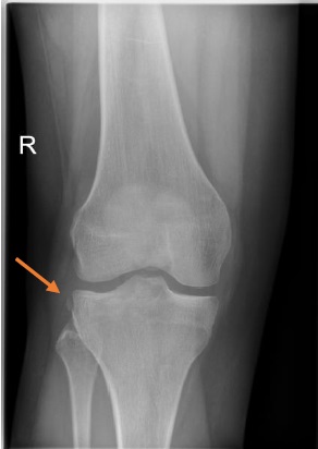 Segond fracture