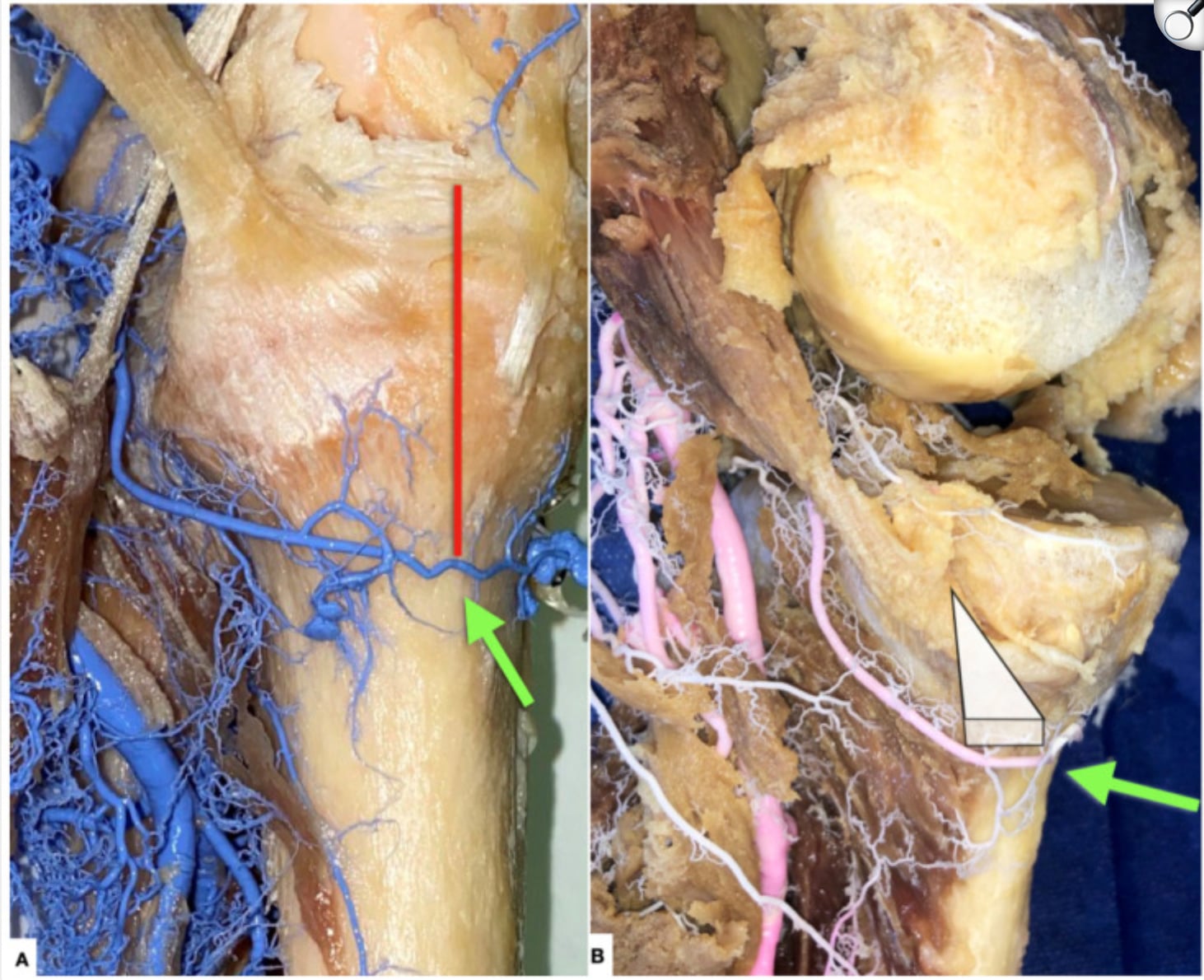 inferior medial geniculate artery (IMGA)