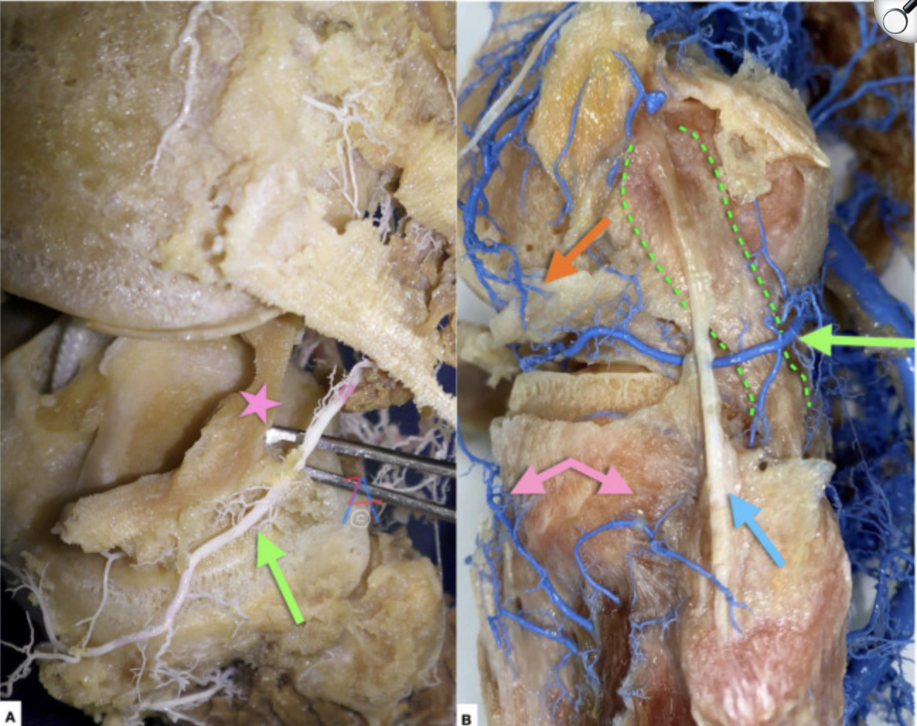 Lateral Inferior Genicular Artery (LIGA) 